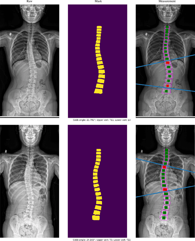 Figure 3 for Analysis of Scoliosis From Spinal X-Ray Images