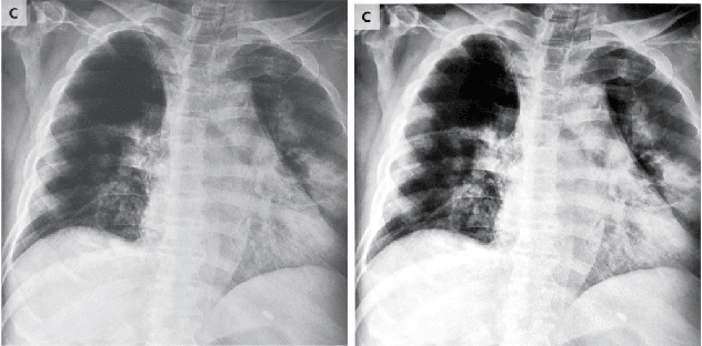 Figure 3 for COVID-MobileXpert: On-Device COVID-19 Screening using Snapshots of Chest X-Ray