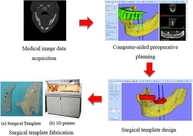 Figure 1 for A semi-automatic computer-aided method for surgical template design