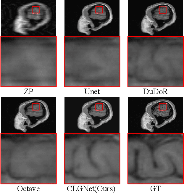 Figure 1 for Contrastive Learning for Local and Global Learning MRI Reconstruction