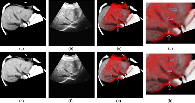 Figure 4 for Non-rigid Registration Method between 3D CT Liver Data and 2D Ultrasonic Images based on Demons Model
