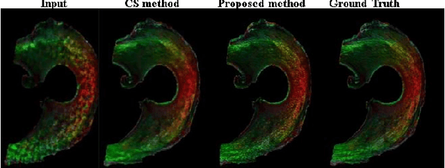 Figure 4 for Self-Learned Kernel Low Rank Approach TO Accelerated High Resolution 3D Diffusion MRI
