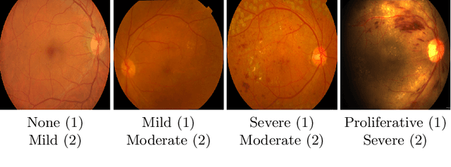 Figure 1 for GREEN: a Graph REsidual rE-ranking Network for Grading Diabetic Retinopathy