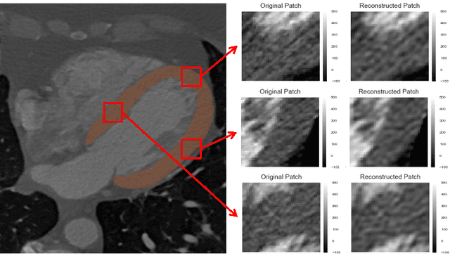 Figure 4 for Combined analysis of coronary arteries and the left ventricular myocardium in cardiac CT angiography for detection of patients with functionally significant stenosis