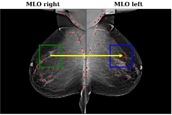 Figure 2 for Improving Breast Cancer Detection using Symmetry Information with Deep Learning