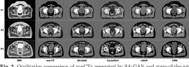 Figure 4 for SA-GAN: Structure-Aware Generative Adversarial Network for Shape-Preserving Synthetic CT Generation