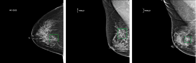 Figure 1 for Learning from Suspected Target: Bootstrapping Performance for Breast Cancer Detection in Mammography