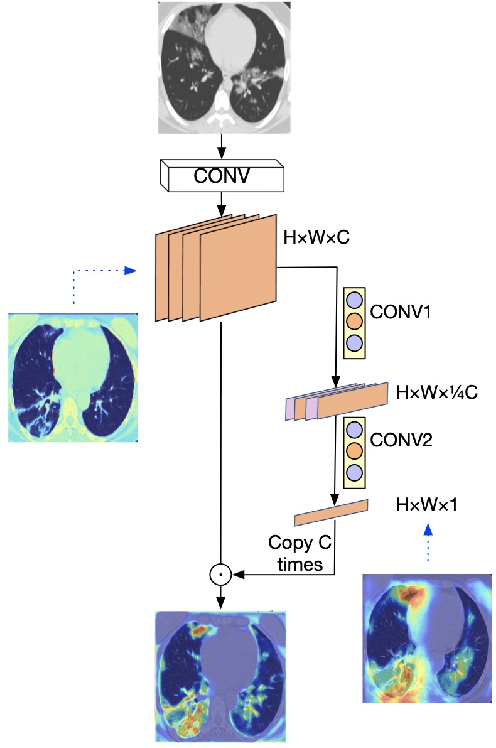 Figure 3 for Multi-scale alignment and Spatial ROI Module for COVID-19 Diagnosis