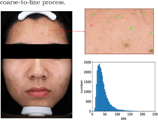 Figure 1 for Learning High-quality Proposals for Acne Detection