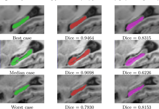 Figure 4 for Near Real-time Hippocampus Segmentation Using Patch-based Canonical Neural Network
