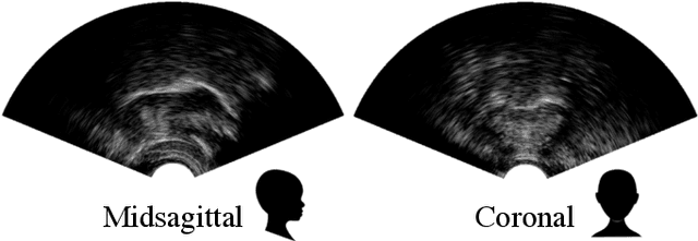 Figure 3 for Automatic audiovisual synchronisation for ultrasound tongue imaging
