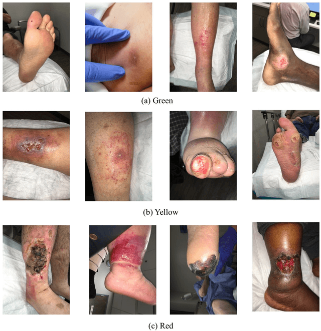 Figure 3 for Wound Severity Classification using Deep Neural Network