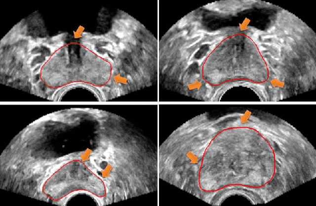 Figure 1 for Deep Attentive Features for Prostate Segmentation in 3D Transrectal Ultrasound