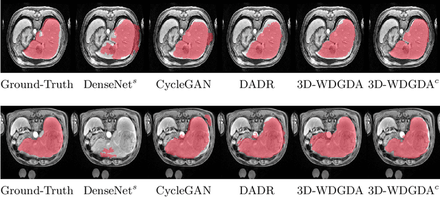 Figure 3 for Unsupervised Wasserstein Distance Guided Domain Adaptation for 3D Multi-Domain Liver Segmentation