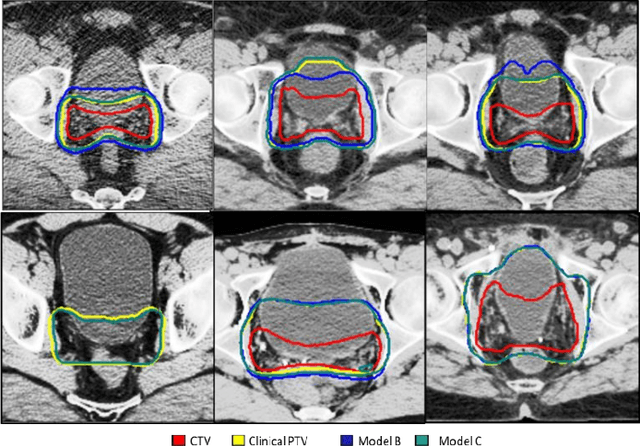 Figure 4 for Dosimetric impact of physician style variations in contouring CTV for post-operative prostate cancer: A deep learning based simulation study