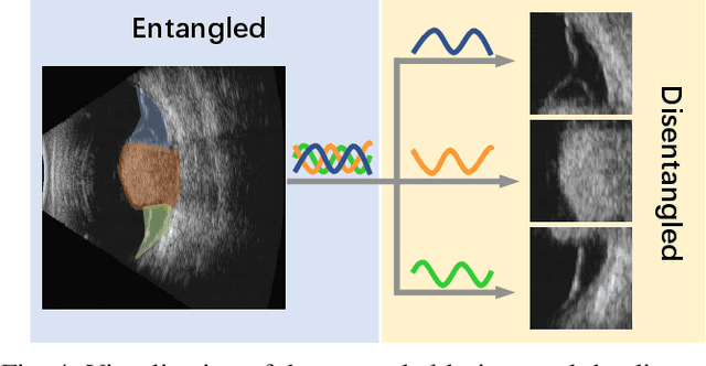 Figure 4 for CDNet: Contrastive Disentangled Network for Fine-Grained Image Categorization of Ocular B-Scan Ultrasound