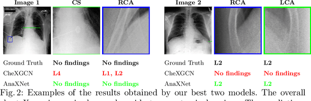 Figure 4 for AnaXNet: Anatomy Aware Multi-label Finding Classification in Chest X-ray