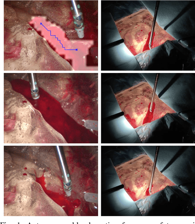 Figure 1 for Autonomous Robotic Suction to Clear the Surgical Field for Hemostasis using Image-based Blood Flow Detection