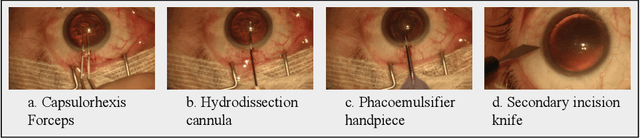 Figure 1 for DeepPhase: Surgical Phase Recognition in CATARACTS Videos