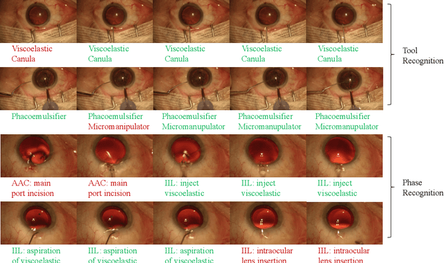 Figure 4 for DeepPhase: Surgical Phase Recognition in CATARACTS Videos