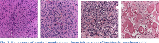 Figure 4 for Texture measures combination for improved meningioma classification of histopathological images
