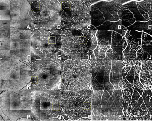 Figure 3 for Generating retinal flow maps from structural optical coherence tomography with artificial intelligence