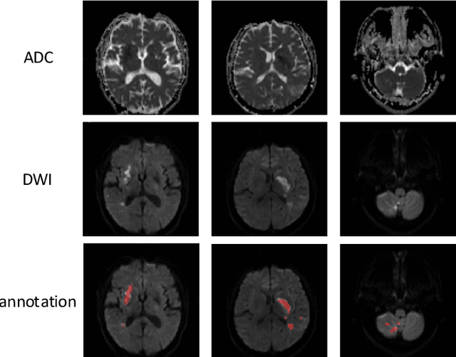 Figure 3 for Automatic acute ischemic stroke lesion segmentation using semi-supervised learning