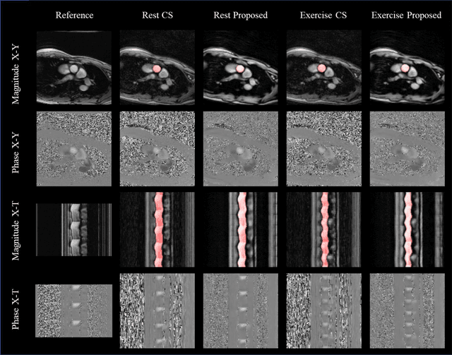 Figure 4 for FReSCO: Flow Reconstruction and Segmentation for low latency Cardiac Output monitoring using deep artifact suppression and segmentation