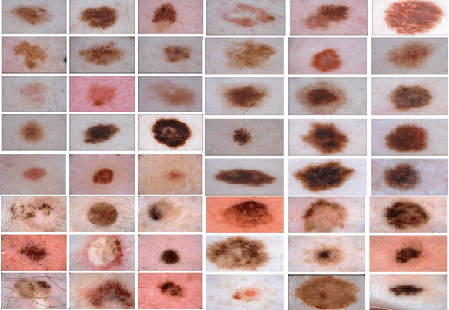 Figure 3 for Discovery Radiomics via Deep Multi-Column Radiomic Sequencers for Skin Cancer Detection
