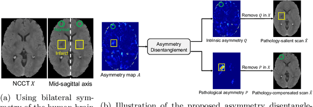 Figure 1 for Asymmetry Disentanglement Network for Interpretable Acute Ischemic Stroke Infarct Segmentation in Non-Contrast CT Scans