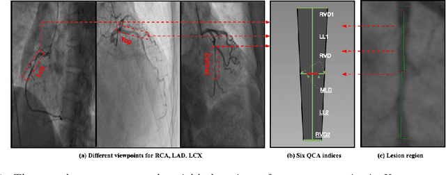 Figure 1 for Direct Quantification for Coronary Artery Stenosis Using Multiview Learning