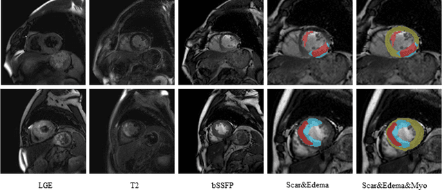 Figure 1 for AWSnet: An Auto-weighted Supervision Attention Network for Myocardial Scar and Edema Segmentation in Multi-sequence Cardiac Magnetic Resonance Images