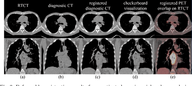 Figure 4 for Accurate Esophageal Gross Tumor Volume Segmentation in PET/CT using Two-Stream Chained 3D Deep Network Fusion