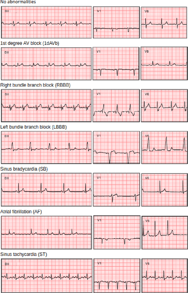 Figure 4 for Automatic Diagnosis of Short-Duration 12-Lead ECG using a Deep Convolutional Network