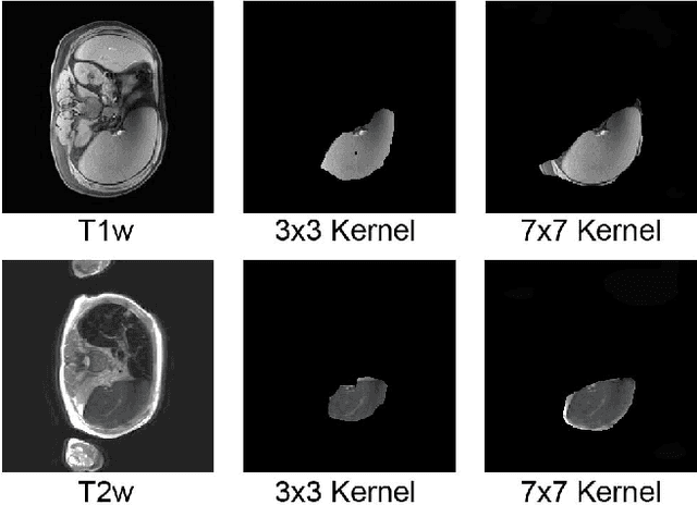 Figure 4 for Splenomegaly Segmentation on Multi-modal MRI using Deep Convolutional Networks