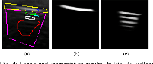 Figure 4 for Weakly- and Semi-Supervised Probabilistic Segmentation and Quantification of Ultrasound Needle-Reverberation Artifacts to Allow Better AI Understanding of Tissue Beneath Needles