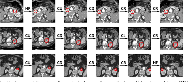 Figure 3 for Automatic Data Augmentation via Deep Reinforcement Learning for Effective Kidney Tumor Segmentation