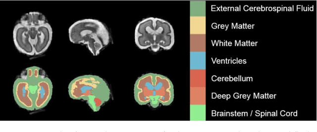 Figure 2 for A comparison of automatic multi-tissue segmentation methods of the human fetal brain using the FeTA Dataset