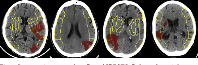 Figure 1 for Deep-ASPECTS: A Segmentation-Assisted Model for Stroke Severity Measurement