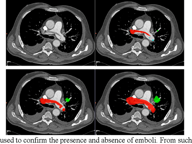 Figure 2 for Computer Aided Detection for Pulmonary Embolism Challenge (CAD-PE)