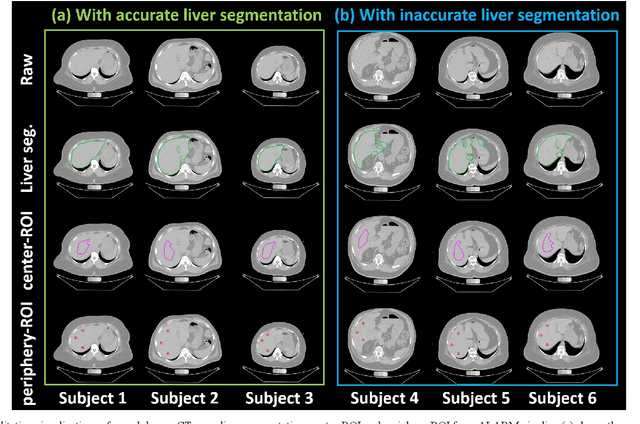 Figure 4 for Fully Automatic Liver Attenuation Estimation Combing CNN Segmentation and Morphological Operations