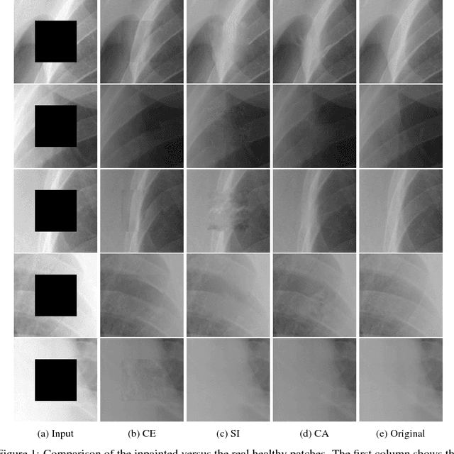 Figure 2 for Chest X-ray Inpainting with Deep Generative Models