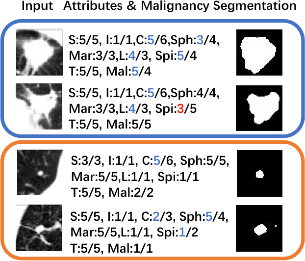 Figure 4 for Joint Learning for Pulmonary Nodule Segmentation, Attributes and Malignancy Prediction