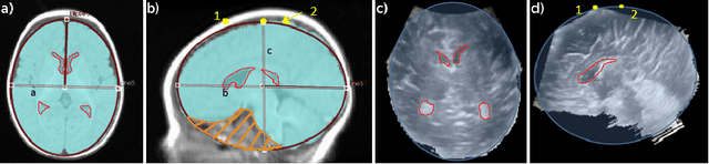 Figure 1 for Dilatation of Lateral Ventricles with Brain Volumes in Infants with 3D Transfontanelle US