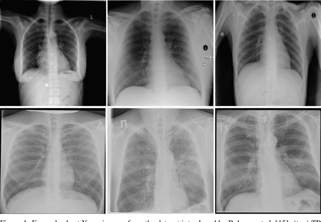 Figure 1 for TB-Net: A Tailored, Self-Attention Deep Convolutional Neural Network Design for Detection of Tuberculosis Cases from Chest X-ray Images