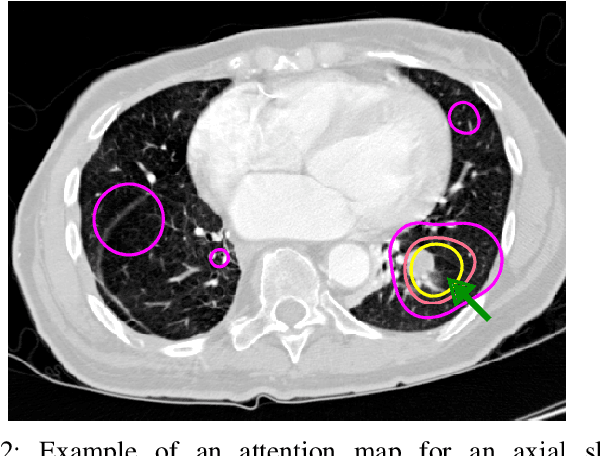 Figure 2 for Did you miss it? Automatic lung nodule detection combined with gaze information improves radiologists' screening performance