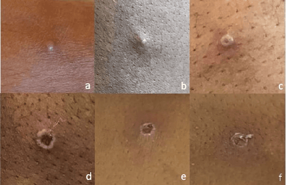 Figure 2 for Monkeypox Skin Lesion Detection Using Deep Learning Models: A Feasibility Study