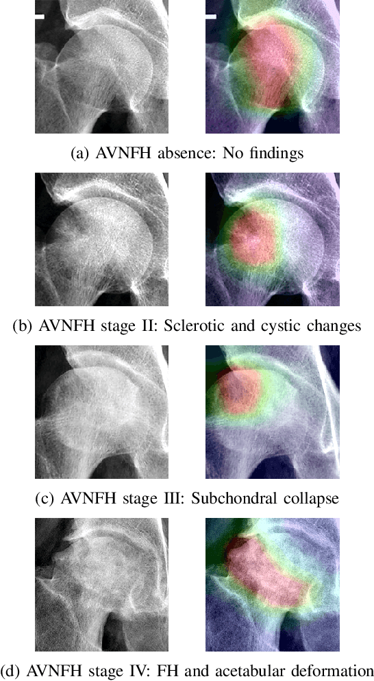 Figure 1 for Deep Learning-based End-to-end Diagnosis System for Avascular Necrosis of Femoral Head