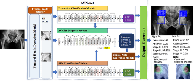 Figure 2 for Deep Learning-based End-to-end Diagnosis System for Avascular Necrosis of Femoral Head