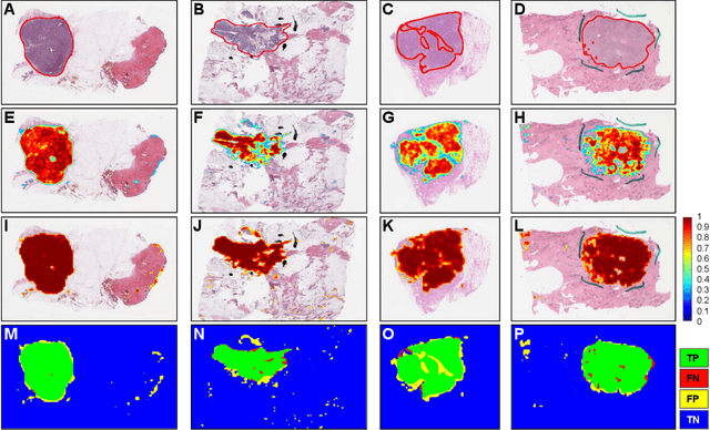 Figure 2 for Utilizing Automated Breast Cancer Detection to Identify Spatial Distributions of Tumor Infiltrating Lymphocytes in Invasive Breast Cancer